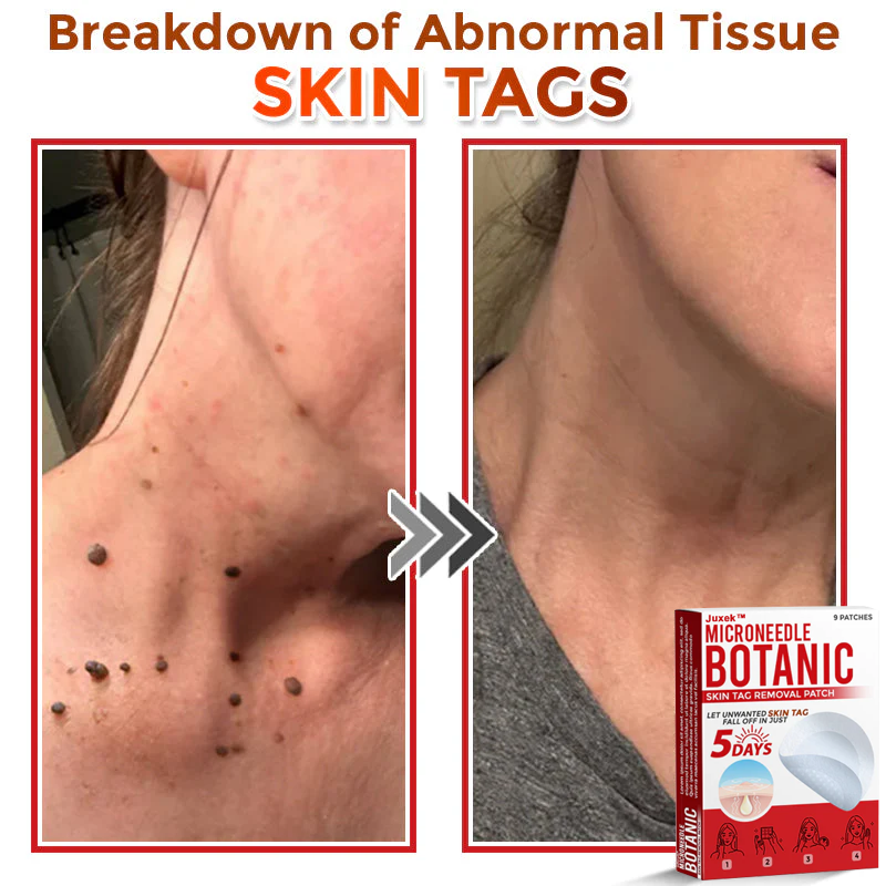 The QuickTag Removal Patch